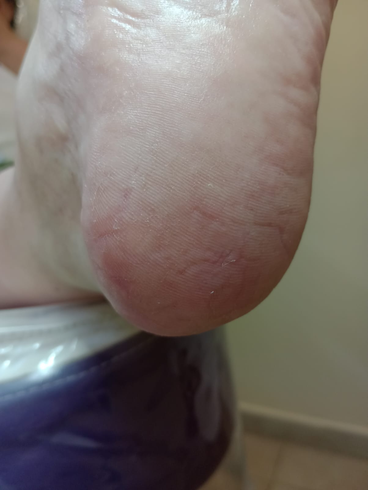 Después del tratamiento de Talones agrietados